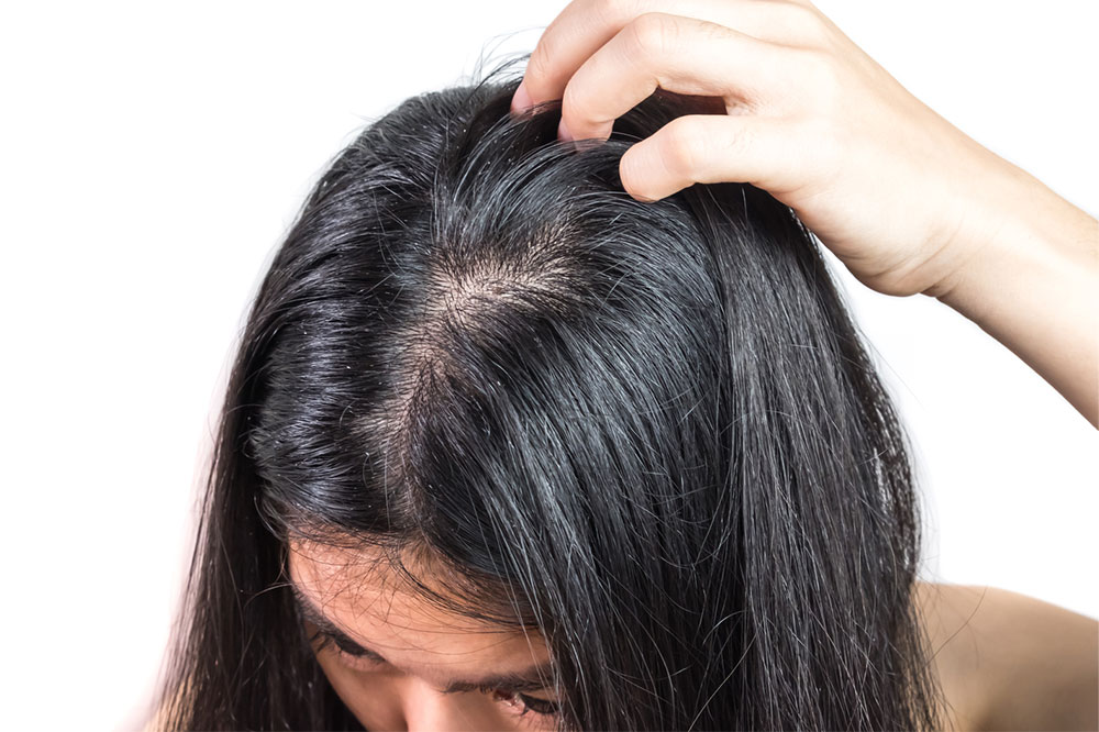 5 Pantry Products That can Treat Dandruff