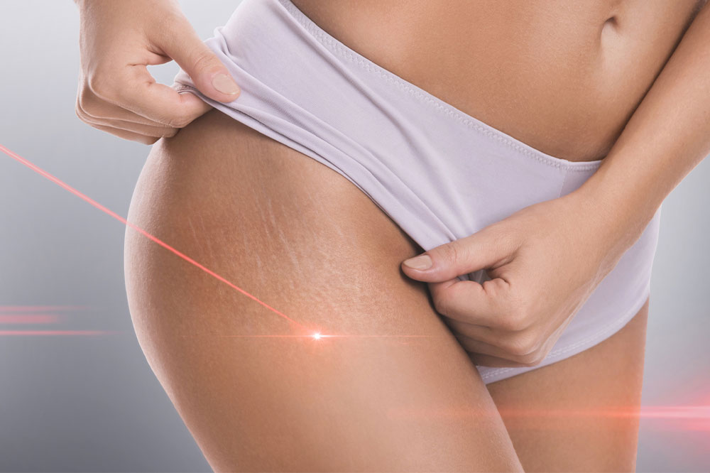 5 Things to Know About Treating Stretch Marks